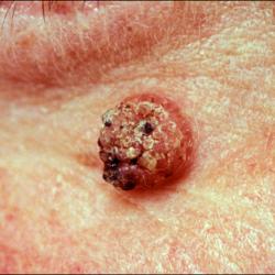 Example of skinLumpsAndBumps